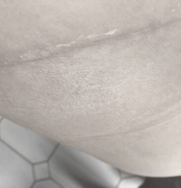 Scars after abdominoplasty